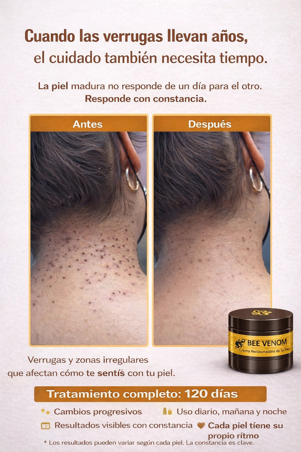 BEE VENOM : Elimina Manchas y Verrugas