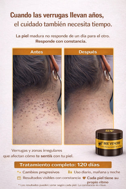 BEE VENOM : Elimina Manchas y Verrugas