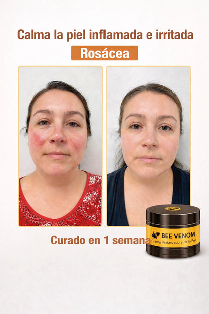 BEE VENOM : Elimina Manchas y Verrugas